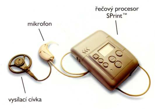 Kompaktní, přenosný, krabicový řečový procesor se nosí v kapse nebo na opasku (jeho jednodušší verze dokonce podobně jako klasické sluchadlo za uchem).