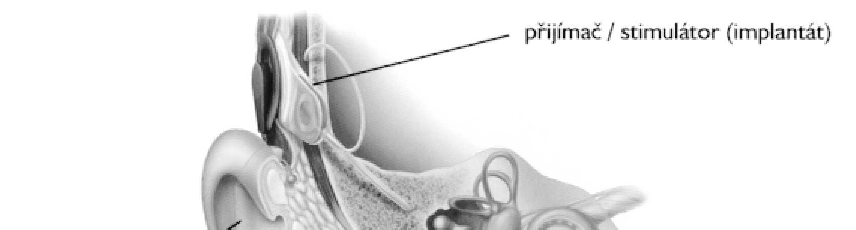 - 30 - Vnitřní části implantátu (dekodér-stimulátor a elektrody) jsou upevněny v hlavě