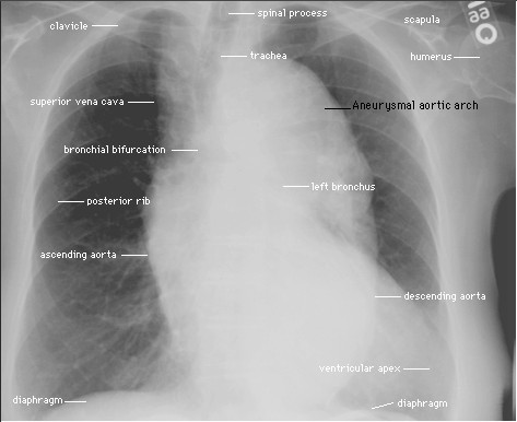 Aneuryzma