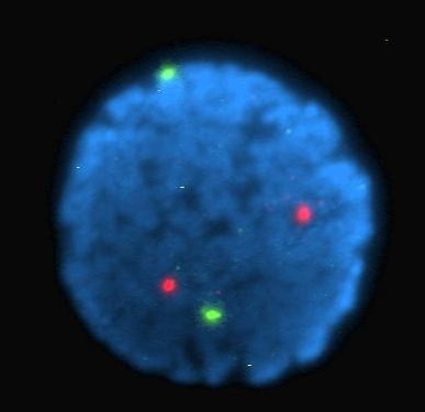 (amplifikace) jednotlivých genů, popřípadě celých chromosomů. Metoda může být použita i pro detekci translokací.