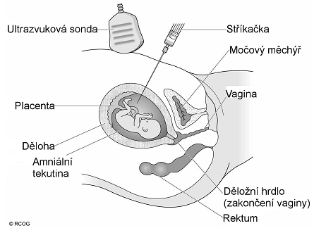 5.1.2 Invazivní metody 5.1.2.1 Amniocentéza (AMC) AMC je ambulantní výkon, při němž je pod UZ kontrolou transabdominálně jehlou odebráno asi 20 ml plodové vody. Provádí se obvykle v období 15. 18.