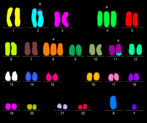 PŘÍLOHA Č. 6 Rekurentní změny 11q oblast 11q23.3 (nemocný č. 26) Karyotyp 46~52,XY,t(2;11)(p24;q23.