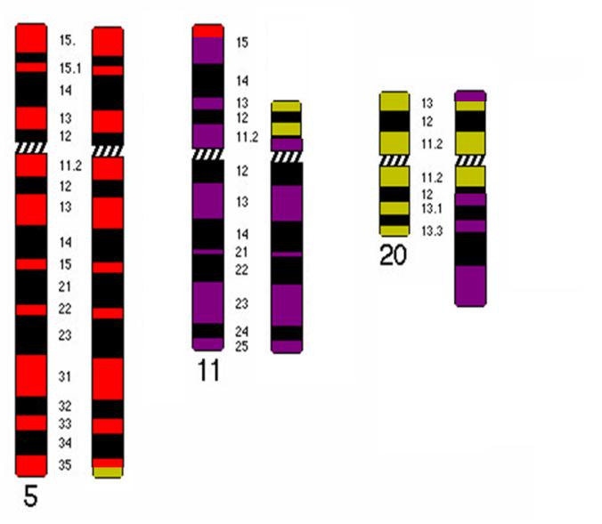 ),der(11)t(5;11)(q35;p15),der(11)t(11;20) (p11.2;q?