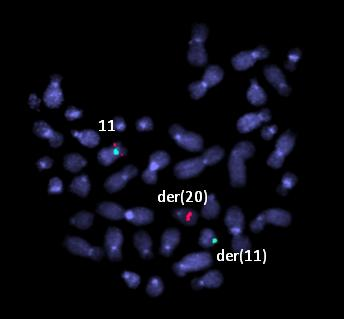 oblasti 11p13. FISH se sondami RP11-340A20 (11p15.
