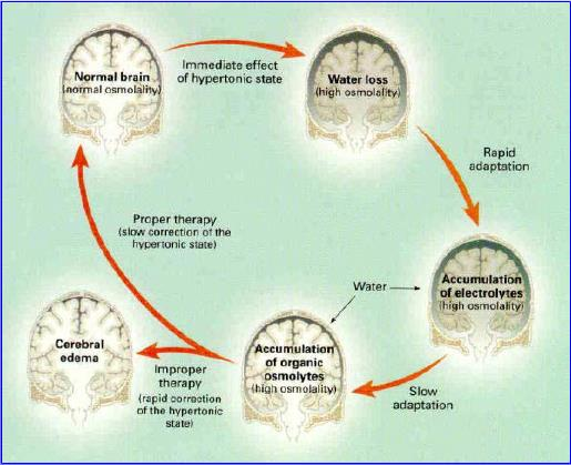 21 Obr. 7 Schématické znázornění přizpůsobení objemu mozku hypernatrémii Převzato z: Adrogué a Madias (2000b) 2.3.2.2 Příznaky Příznaky hypernatrémie se vyskytují v závislosti na stupni a rychlosti vzniku.