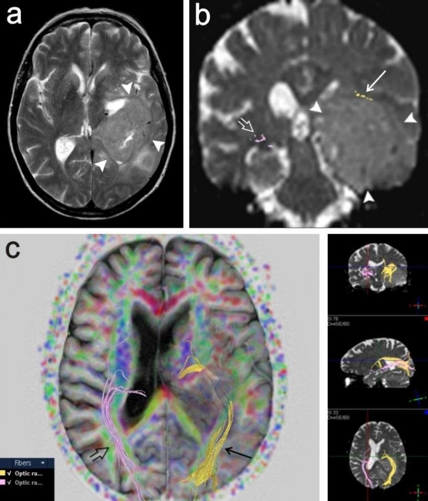 T2 vážený obraz v axiální rovině, tumor má intenzity signálu blízké šedé hmotě mozku (plné šipky). b. Rekonstrukce obou optických drah na průřezu v koronální rovině.