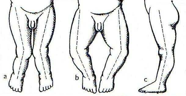 Obr.11: Nesouměrnost tělesná výchova. 1992) thorako-abdominálních trojúhelníků (Pernicová, Zdravotní Dolní končetiny Osa dolních končetin by měla procházet kyčelním kloubem, kolenním a hlezenním.