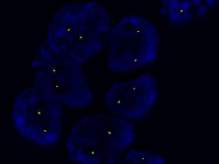 ALK (anaplastic lymphoma kinase) -v ÚMTM vyšetřeno 51 pacientů s NSCLC a 2 s