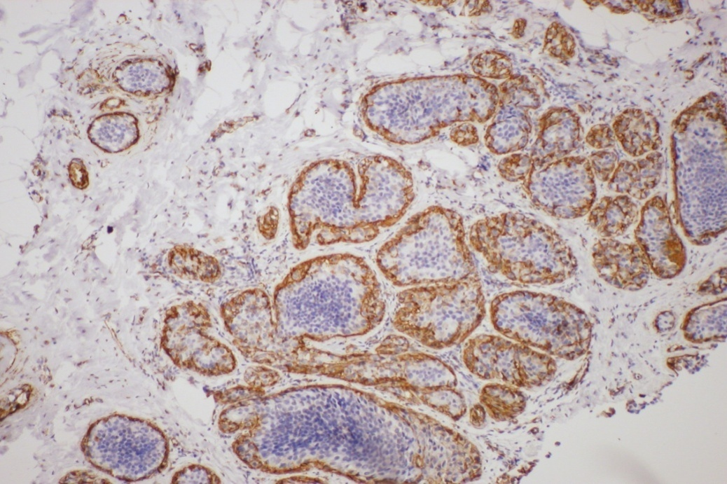 Obrázek 8: Bazální buňky LCIS, cytoplazmatická