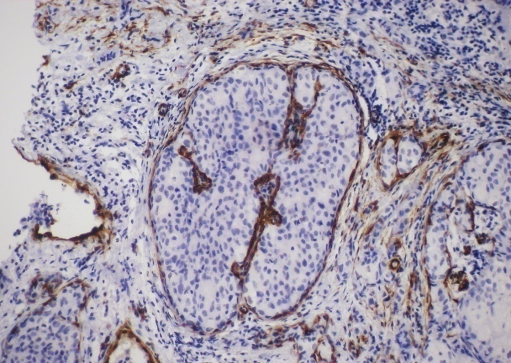 Obrázek 9: Myoepiteliální buňky LCIS,