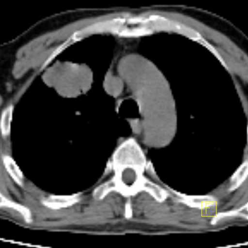 NSCLC CT: