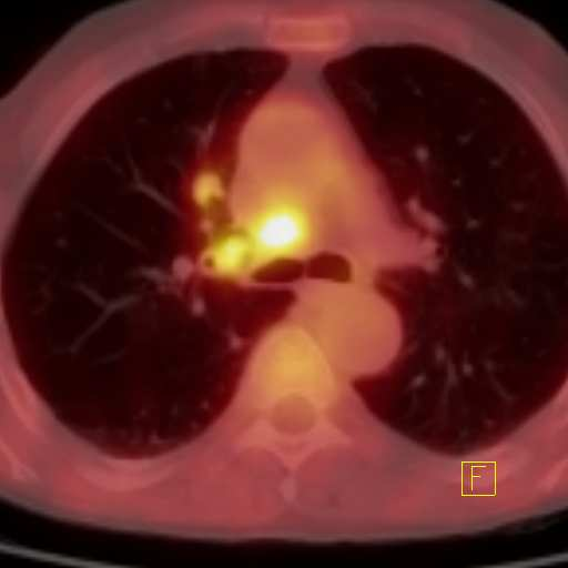 NSCLC CT: T2 N0 Mx ~ stg. IB? PET: T2 N2 M0 ~ stg.