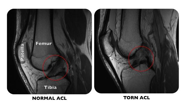 Ultrasonografie zobrazí zvýšenou náplň kloubu i poranění měkkých tkání (Rozkydal, Chaloupka 2001). 1.1.4.8.