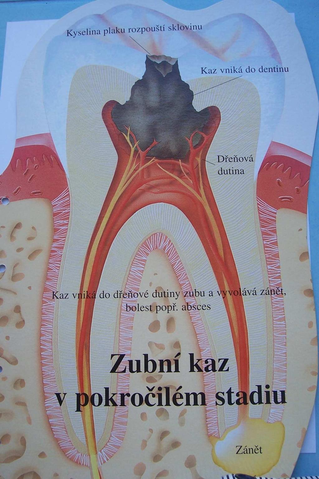 Obr. 29 Zubní kaz