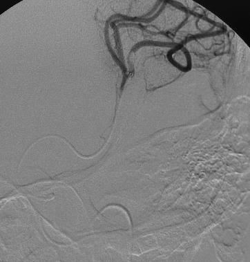 Ischemic Stroke