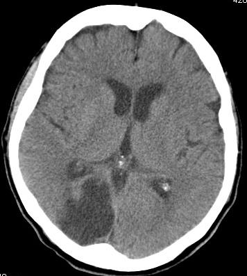 při dimisi NIHSS 1 ko CT mozku bez čerstvé