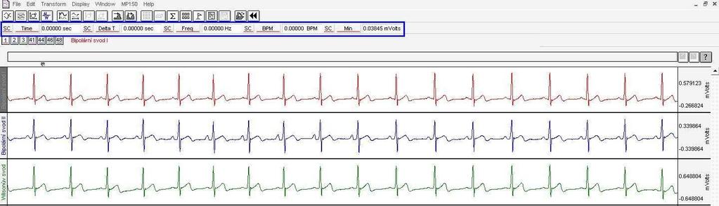 5.1.1 Výběr dat k analýze Obr.17 Dopočítání kanálů [9] Výsledkem měření jsou časové průběhy signálu EKG v programu AcqKnowledge, viz Obr.18.