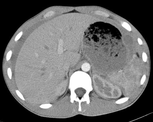 Obr. 2A Obr. 2B Obr. 2. Aktivní krvácení ze sleziny patrné pouze ve venózní fázi CT vyšetření (A, B) Fig. 2. Splenic active extravasation seen only in venous phase of the CT examination (A, B) Obr.