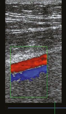 1 Ultrazvukové vyšetření žil dolních končetin A. B. C. Obr. 1.4 Duplexní a triplexní ultrasonografické zobra zení stehenní žíly (vena femoralis) A.