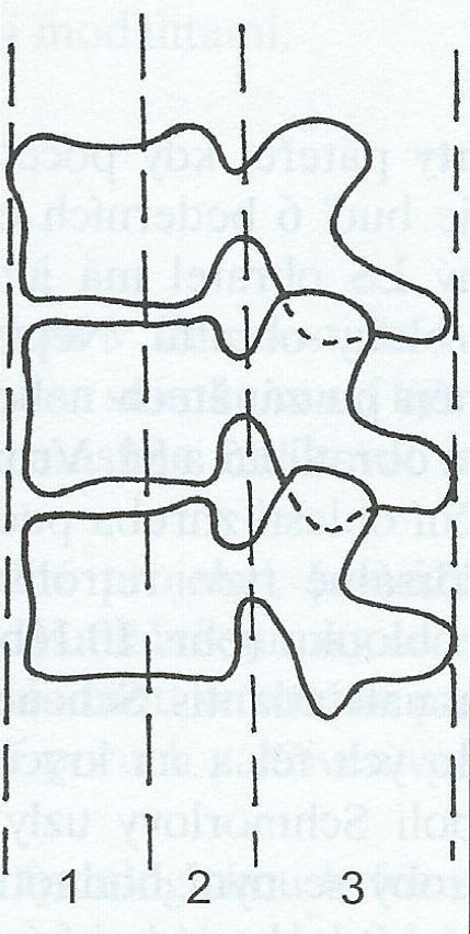 Obrázek 6 Schéma - hodnocení zlomenin, tři sloupce (Nekula, a další, 2005 str. 138) Toto rozdělení dle Denise určuje následnou hospitalizaci pacienta při fraktuře obratle.