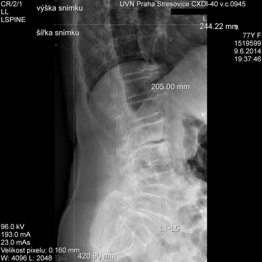 Obrázek 19 Pacient 1 - RTG snímek v