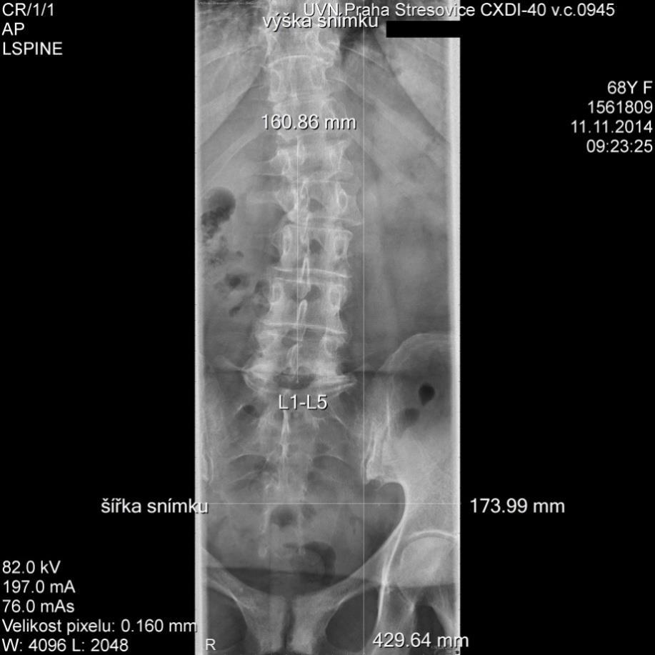Obrázek 23 Pacient 3 - RTG snímek v