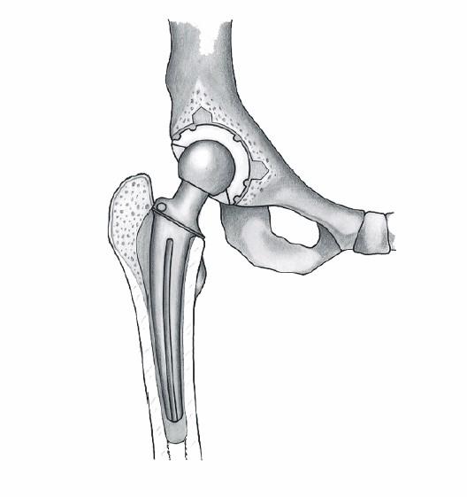 Avšak díky novým materiálům a pokrokům v chirurgii je v současné době ortopedie schopna tento problém vyřešit. Náhrada devastovaného kloubu implantátem pak vede k ústupu bolesti a návratu funkce. 1.