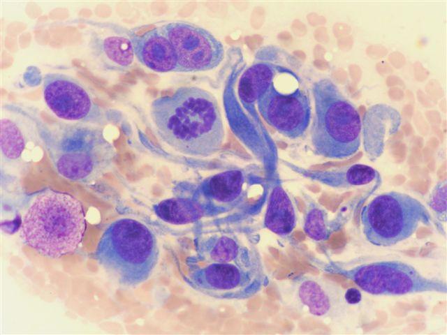 44 8.3. Maligní fibrózní histiocytom Obr. 13: FNAB z útvaru na boku (fretka; samice; 5 let).