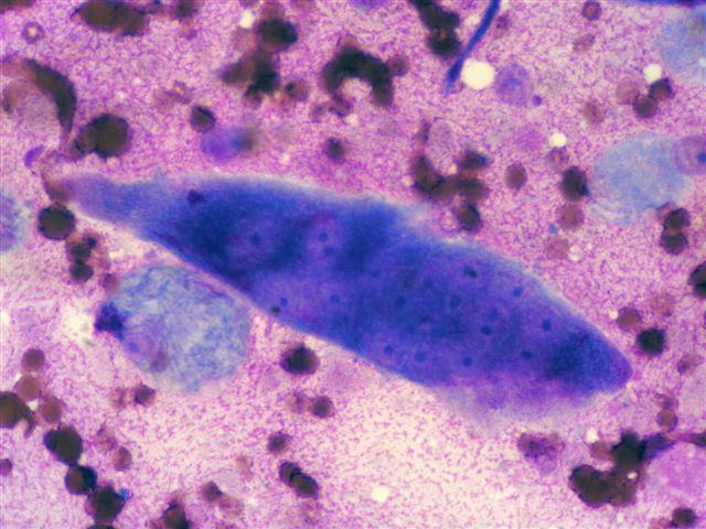 makrojadérka, atypická mitóza). Cytologická diagnóza: maligní fibrózní histiocytom. Histologická diagnóza: maligní fibrózní histiocytom. MayGrünwald/Giemsa, 250x Obr.