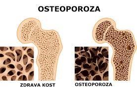 Nedostatek Nedostatek Ca = osteoporóza Dle WHO: Progredující systémové onemocnění skeletu charakterizované stupněm úbytku kostní hmoty a poruchami mikroarchitektury kostní tkáně a v důsledku toho