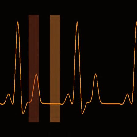 2 EKG synchronizace Mimo zobrazení srdce znamenala možnost spirálního záznamu dat při kontinuálním pohybu stolu velký pokrok směrem k objemovému zobrazení.