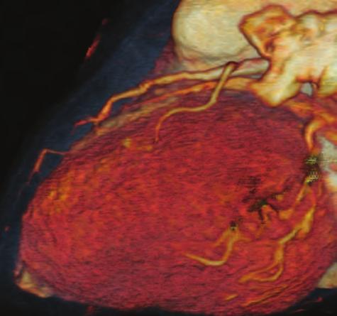 multifázová rekonstrukce ( multiphase reconstruction ) představuje sady axiálních obrazů v jednotlivých částech R-R intervalu s fixními časovými odstupy, které jsou stanoveny pomocí procentuálního