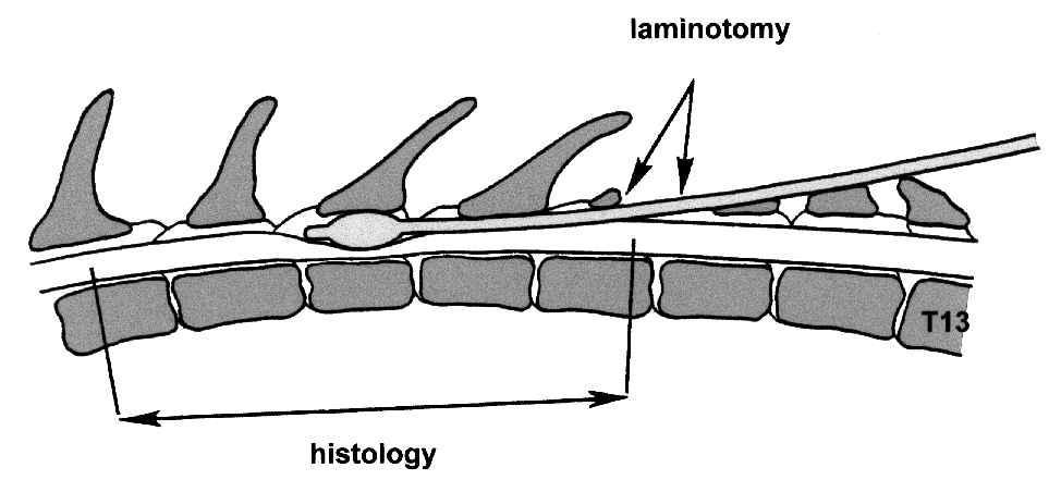 vytvoří kompresi na míšní tkáň (viz obrázek 4). Komprese balónkovou lézí má navíc tu výhodu, nevyžaduje laminektomii. Obr.