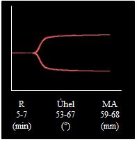 Obrázek 12 Tromboelastografická křivka plné krve Hodnoceny 3 parametry R, Úhel, MA.
