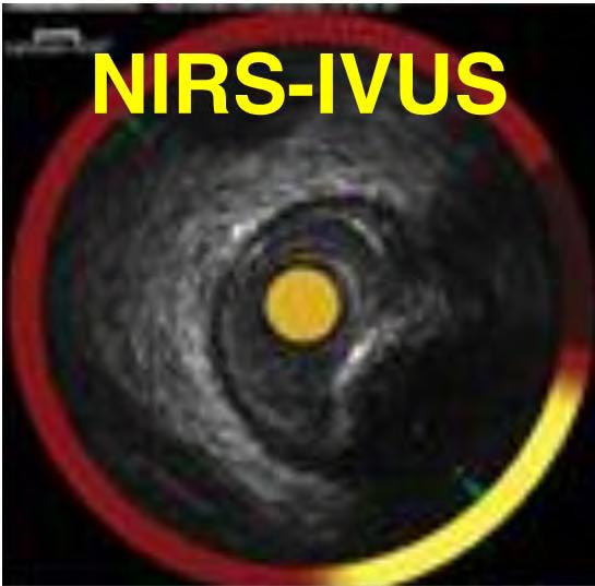 NIRS - princip Near infra-red spectroscopy Vysílač emituje světlo o vlnové délce 780-2500 nm Světlo je absorbováno tkáněmi v závislosti na jejich