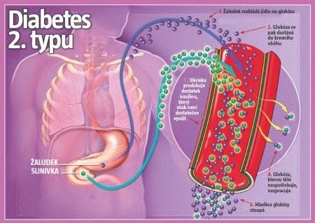 Diabetes mellitus prvního typu vzniká v důsledku destrukce (ničení) specifického typu buněk B buněk (beta-buněk), které se nachází v Langerhansových ostrůvcích pankreatu (slinivky břišní).