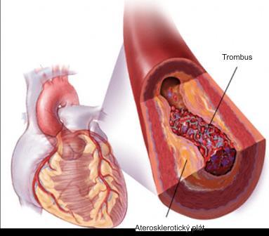 PŘÍLOHA B TROMBUS V KORONÁRNÍ TEPNĚ Obrázek č.