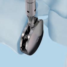 Vysuňte pouzdro (1) a otočte zkušební implantát nervosvalové ploténky do požadované polohy