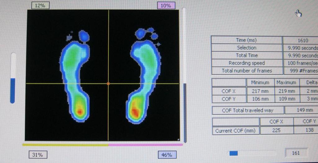 2. Výsledky plantografického vyšetření přístrojem Footscan Pacient: P.D. STOJ 1 - Vstupní měření (vlastní foto) Tento snímek byl pořízen při vstupním vyšetření pacientky P.D. Vyplývá z něj, že největší zatížení je v oblasti pat.