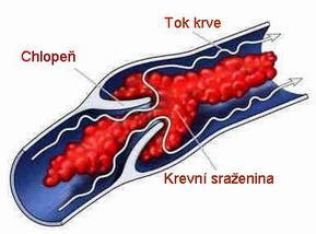 3.4 Trombóza a tromboembolická nemoc (TEN) Patogeneze trombózy je multifaktoriální (vzájemné ovlivňování rizikových faktorů, interakce genové, prostředí, ovlivnění věkem) a v posledních letech byla