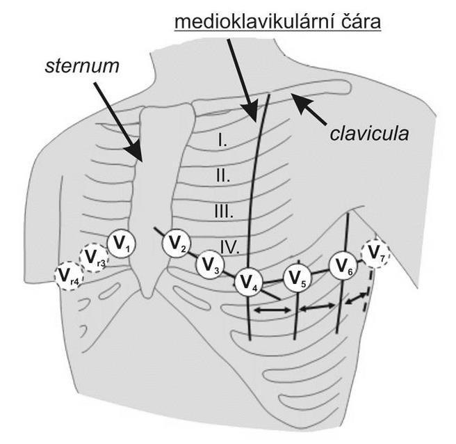 Unipolární hrudní svody podle Wilsona (obr. 3.3) zobrazují aktivitu srdce do horizontální roviny, zatímco končetinové svody do frontální roviny.