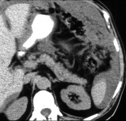 4. Lig. gastrolienale (gastrosplenicum) probíhá od hilu sleziny k velké křivině žaludku. Probíhají v něm větve a. lienalis určené pro žaludek.