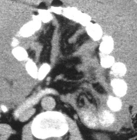 8. Mesenterium Jeho kořen radix mesenterii - se