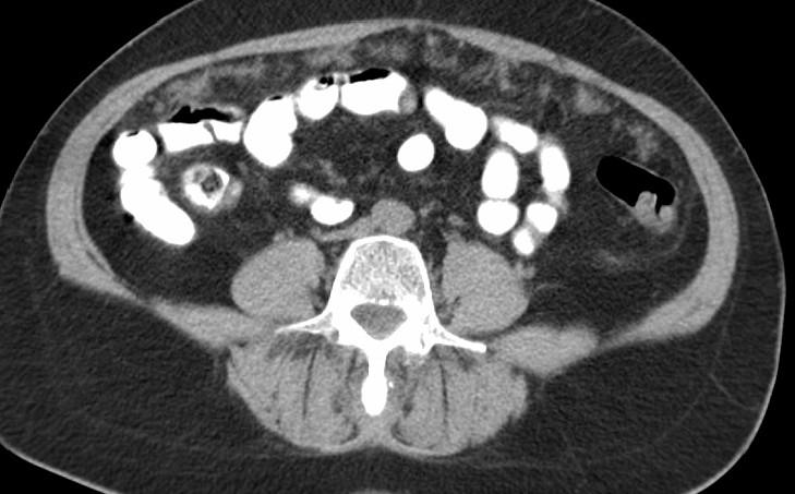 Peritoneum, infiltrace,