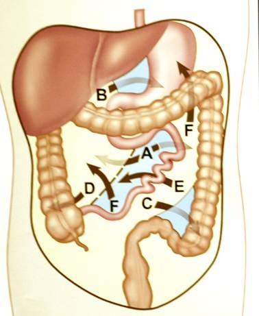 A Paraduodenální B foramen Winslowi C