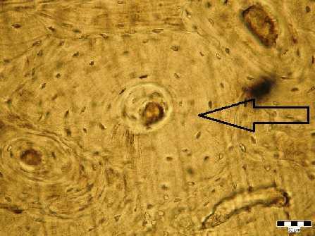 Obr. 33. Osteon s dočasně pozastaveným a opět obnoveným procesem uzavírání Haversova kanálku (šipka). Zvětšení 400. Muž, 65 let. v okolí (Stout, 1992).