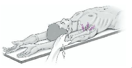 Obr. č. 8 Supine flexion resistance test (Ebinger, et al., 2008) 2.5.4 Operační postupy u pacientů se SLAP lézí SLAP léze nelze řešit konzervativními metodami.