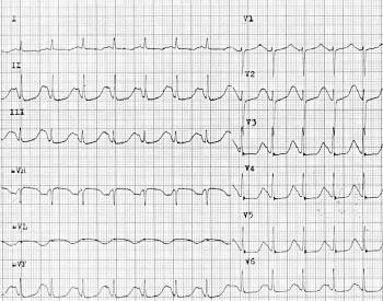 Long QT Obr. 1. Typický EKG obraz syndromu dlouhého EKG intervalu. Obr. 2. Krátká dlouhá krátká sekvence předcházející vznik TdP. Tyto elektrofyziologické abnormality (obr.