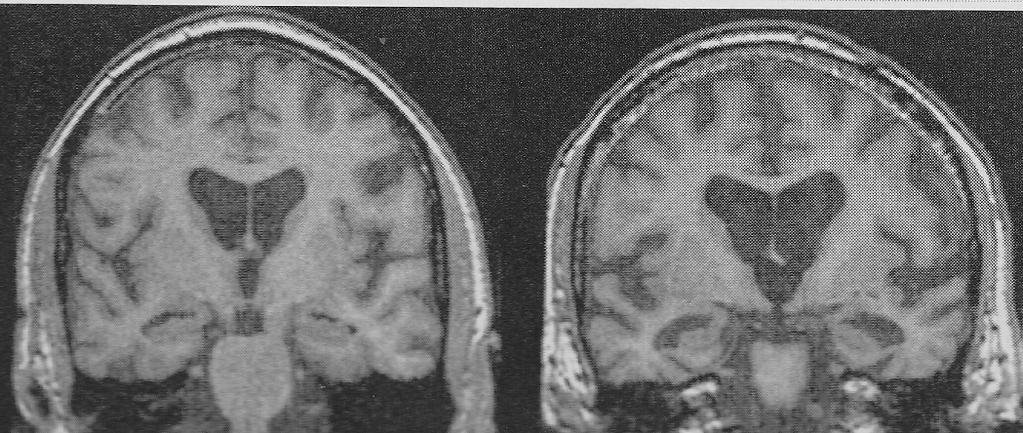 1016/j.neurobiolaging.2013.02.