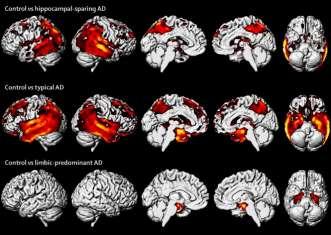 Neuropathologically defined subtypes of Alzheimer's disease with distinct clinical characteristics: a retrospective study, Lancet Neurology, Volume 10, Issue 9, 2011 Iniciální klinická prezentace S